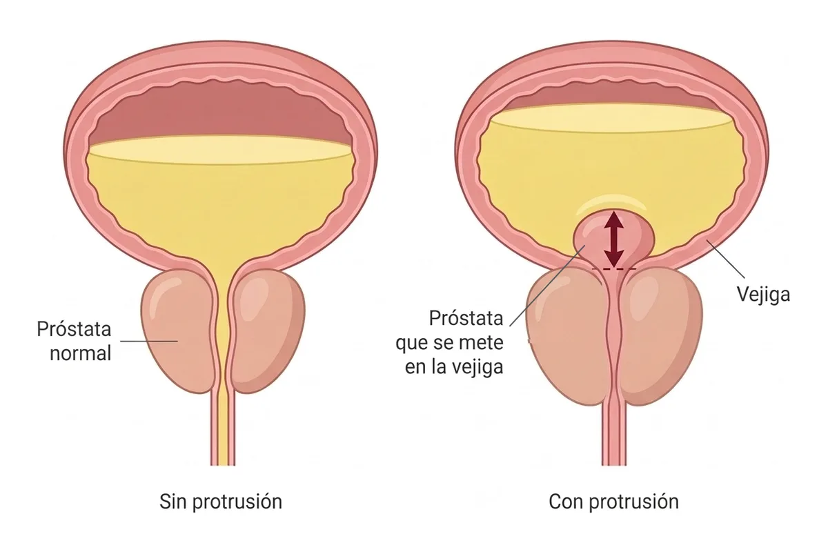 Dos dibujos de la vejiga con orina amarilla y la próstata debajo: a la izquierda, una próstata normal que queda por debajo de la vejiga; a la derecha, una próstata agrandada que se mete en la vejiga, con una flecha roja que marca cuánto sobresale.