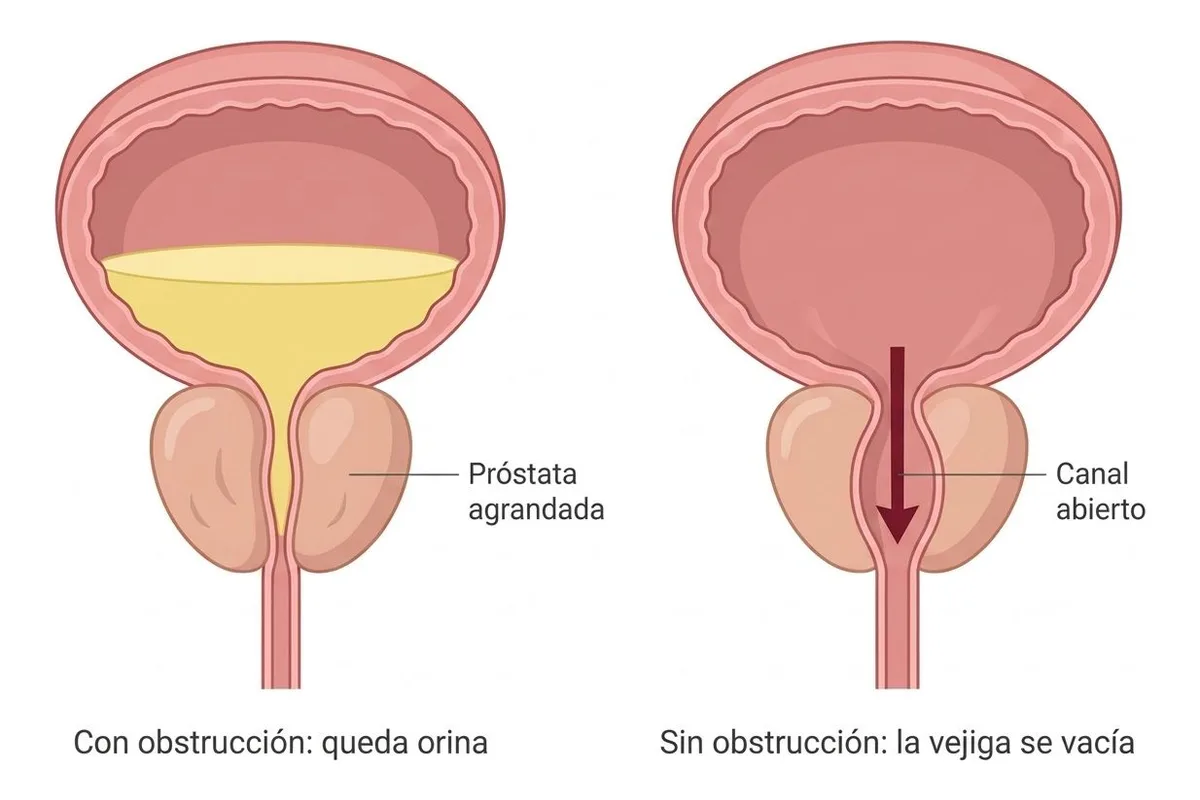 Dos dibujos de la vejiga después de orinar: a la izquierda, la próstata agrandada estrecha la salida y queda orina amarilla dentro; a la derecha, tras la cirugía la próstata tiene un canal abierto, la orina sale y la vejiga queda vacía.