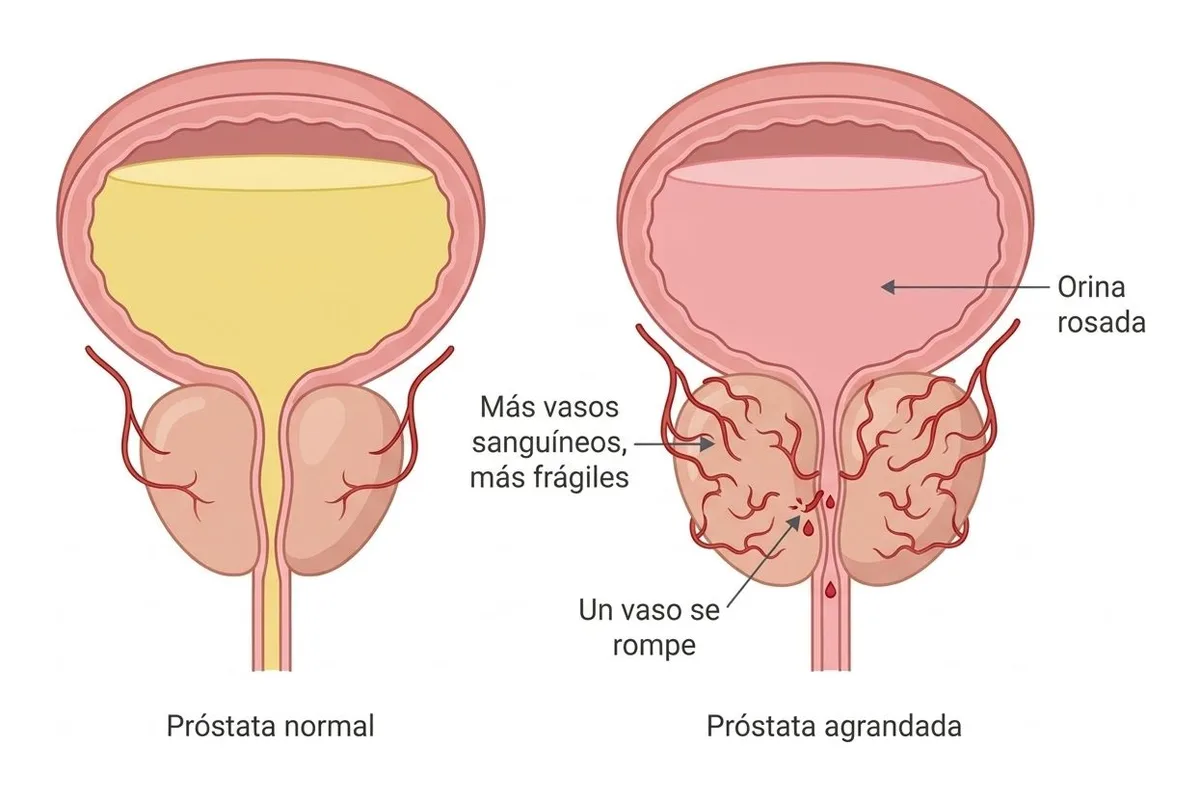 Dos dibujos de la vejiga y la próstata: a la izquierda, una próstata normal con pocos vasos y orina amarilla; a la derecha, una próstata agrandada cubierta de muchos vasos rojos delgados, uno roto que suelta gotas de sangre y orina rosada en la vejiga.